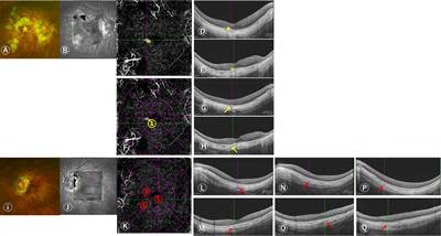 Comparative analysis of macular characteristics in mCNV and contralateral eyes